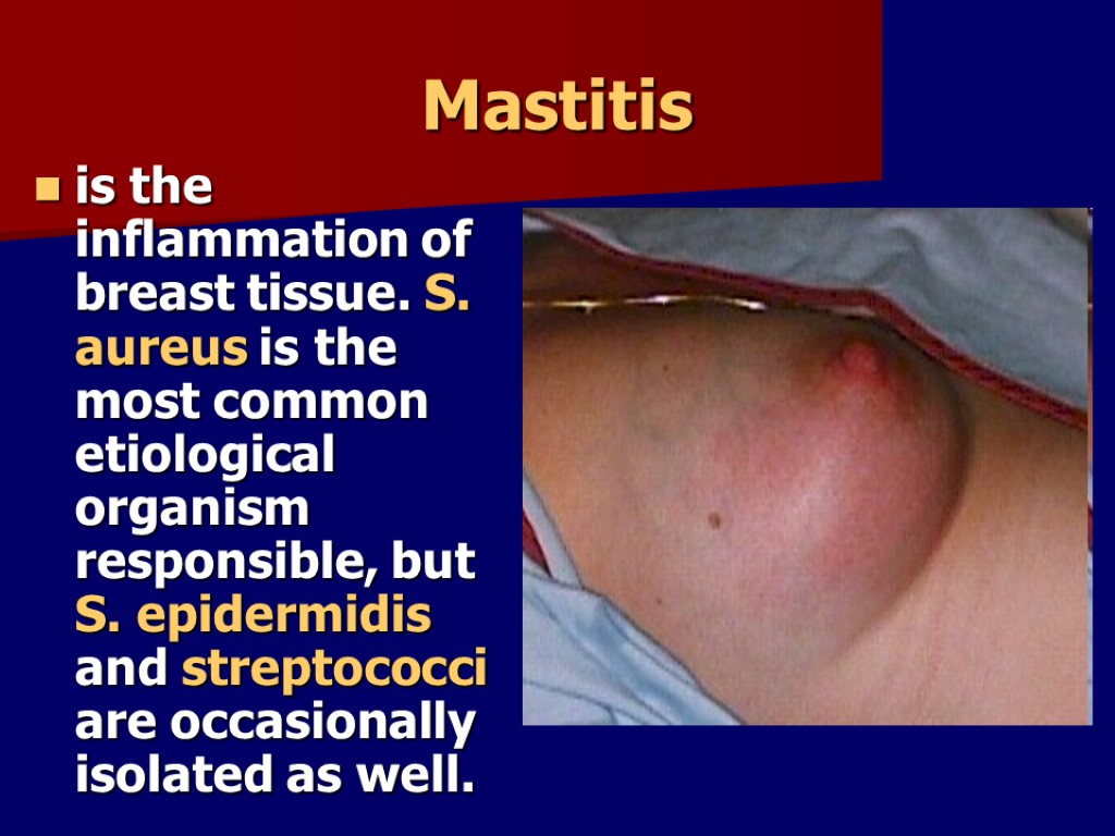 Mastitis is the inflammation of breast tissue. S. aureus is the most common etiological